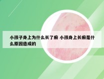 小孩子身上为什么长了癣 小孩身上长癣是什么原因造成的