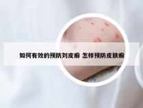 如何有效的预防刘皮癣 怎样预防皮肤癣