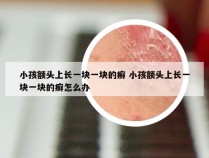 小孩额头上长一块一块的癣 小孩额头上长一块一块的癣怎么办