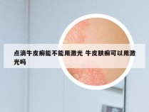 点滴牛皮癣能不能用激光 牛皮肤癣可以用激光吗