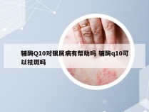 辅酶Q10对银屑病有帮助吗 辅酶q10可以祛斑吗