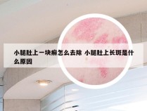 小腿肚上一块癣怎么去除 小腿肚上长斑是什么原因