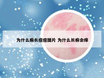 为什么癣长痘痘图片 为什么长癣会痒