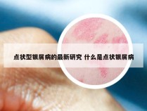 点状型银屑病的最新研究 什么是点状银屑病