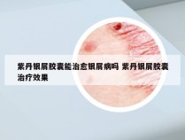 紫丹银屑胶囊能治愈银屑病吗 紫丹银屑胶囊治疗效果