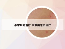 手掌癣的治疗 手掌癣怎么治疗