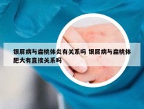 银屑病与扁桃体炎有关系吗 银屑病与扁桃体肥大有直接关系吗