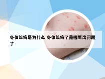 身体长癣是为什么 身体长癣了是哪里出问题了