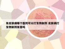 有皮肤病哪个医院可以打生物制剂 皮肤病打生物制剂有害吗