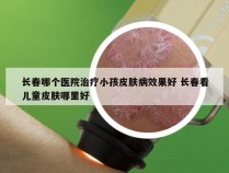 长春哪个医院治疗小孩皮肤病效果好 长春看儿童皮肤哪里好