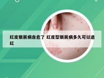 红皮银屑病自愈了 红皮型银屑病多久可以退红