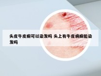 头皮牛皮癣可以染发吗 头上有牛皮病癣能染发吗