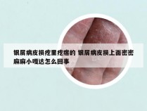 银屑病皮损疙里疙瘩的 银屑病皮损上面密密麻麻小嘎达怎么回事