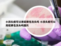 小孩头癣可以用硫磺皂洗头吗 小孩头癣可以用硫磺皂洗头吗图片