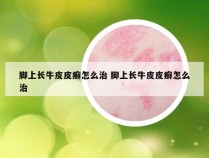 脚上长牛皮皮癣怎么治 脚上长牛皮皮癣怎么治