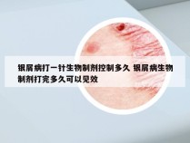 银屑病打一针生物制剂控制多久 银屑病生物制剂打完多久可以见效