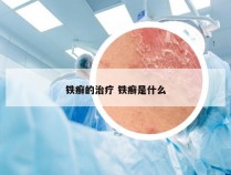 铁癣的治疗 铁癣是什么