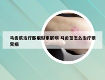 马齿菜治疗脓疱型银屑病 马齿苋怎么治疗银霄病