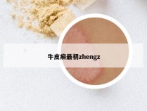 牛皮癣最初zhengz