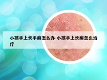 小孩手上长手癣怎么办 小孩手上长癣怎么治疗