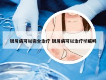 银屑病可以完全治疗 银屑病可以治疗彻底吗