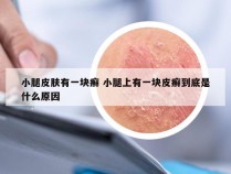 小腿皮肤有一块癣 小腿上有一块皮癣到底是什么原因