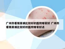 广州市看银屑病比较好的医院哪家好 广州市看银屑病比较好的医院哪家好点