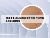 吃维生素b1b6治银屑病有用吗 吃维生素b族能治银屑病