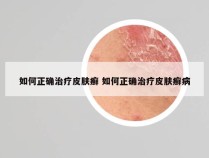 如何正确治疗皮肤癣 如何正确治疗皮肤癣病