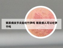 银屑病关节炎能吃竹笋吗 银屑病人可以吃笋干吗