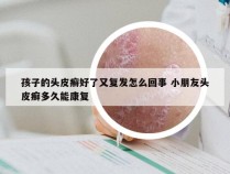 孩子的头皮癣好了又复发怎么回事 小朋友头皮癣多久能康复