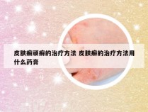 皮肤癣顽癣的治疗方法 皮肤癣的治疗方法用什么药膏