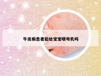 牛皮癣患者能给宝宝喂母乳吗