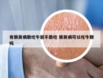 有银屑病敢吃牛筋不敢吃 银屑病可以吃牛鞭吗