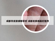 成都市皮肤病哪家好 成都皮肤病最好医院