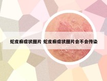 蛇皮癣症状图片 蛇皮癣症状图片会不会传染