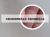 大腿内侧皮肤癣怎么办 大腿内侧癣怎么治