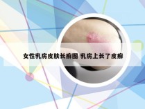 女性乳房皮肤长癣图 乳房上长了皮癣