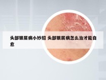 头部银屑病小妙招 头部银屑病怎么治才能自愈