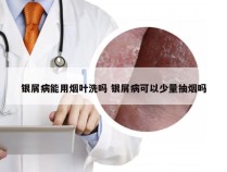 银屑病能用烟叶洗吗 银屑病可以少量抽烟吗