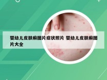 婴幼儿皮肤癣图片症状照片 婴幼儿皮肤癣图片大全