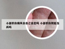 小面积白癜风会自己自愈吗 小面积白斑能当兵吗