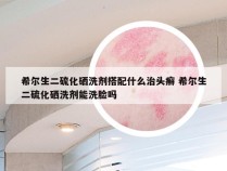 希尔生二硫化硒洗剂搭配什么治头癣 希尔生二硫化硒洗剂能洗脸吗