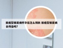 脓疱型银屑病怀孕后怎么预防 脓疱型银屑病会传染吗?