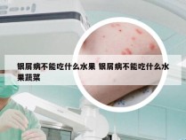 银屑病不能吃什么水果 银屑病不能吃什么水果蔬菜