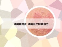 顽癣病图片 顽癣治疗特效验方