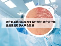 光疗银屑病皮肤变黑多长时间好 光疗治疗银屑病康复后多久不会复发