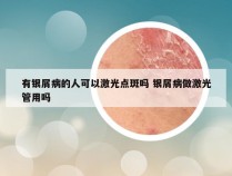 有银屑病的人可以激光点斑吗 银屑病做激光管用吗