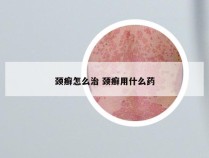 颈癣怎么治 颈癣用什么药