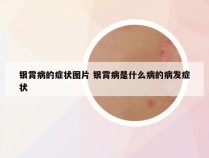 银霄病的症状图片 银霄病是什么病的病发症状